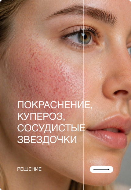 Покраснение, купероз, сосудистые звездочки